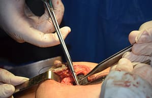 breast surgery